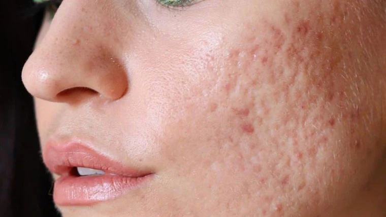 Acne & Acne Scars Treatment
